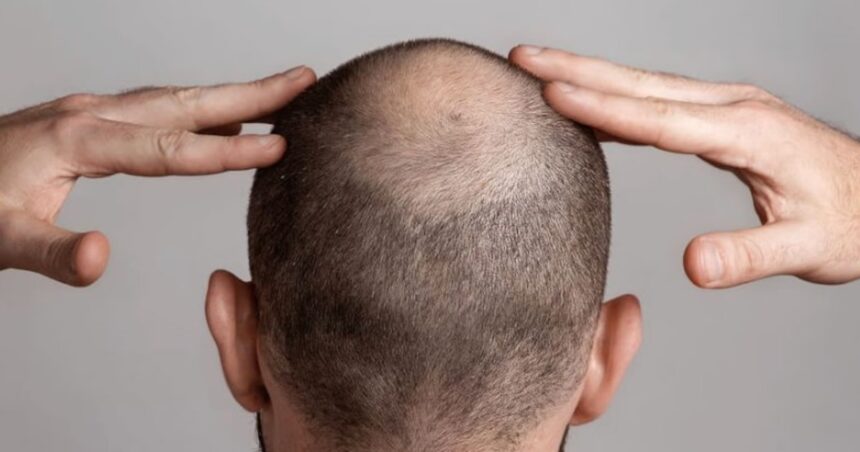 Alopecia: factores que la causan y los distintos tipos