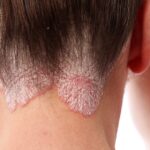 Psoriasis en el cuero cabelludo: causas y tratamientos naturales